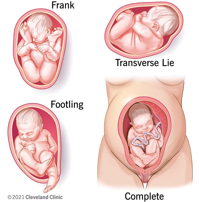 What are the types of breech positions a baby can be in?