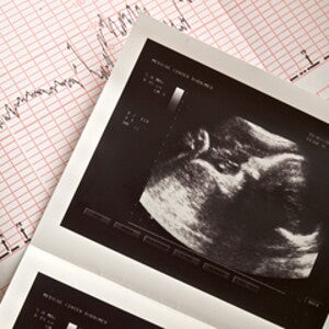 Le rythme cardiaque fœtal peut-il prédire le sexe du bébé ?