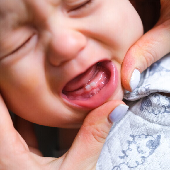 Inflamed Gums